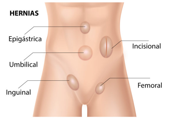 Hernias de Pared Abdominal