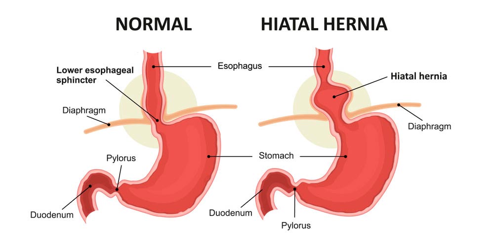 Hernia de Hiato