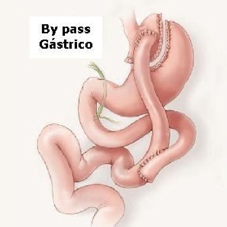 Bypass Gástrico