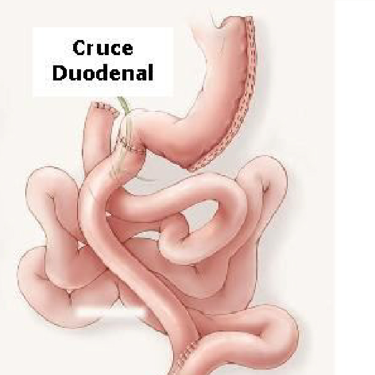 Cruce Duodenal
