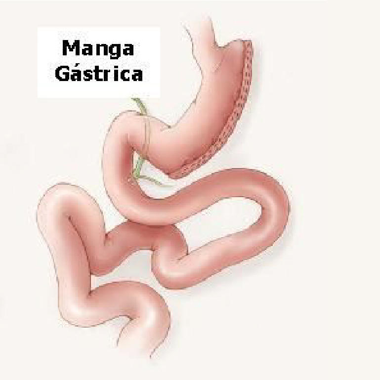 Manga Gástrica