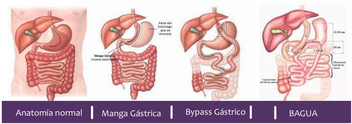 Anatomía normal, Manga Gástrica, Bypass Gástrico y BAGUA: las principales técnicas quirúrgicas.